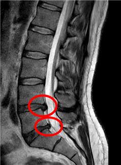 허리 디스크 MRI 영상
